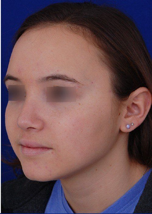 female rhinoplasty