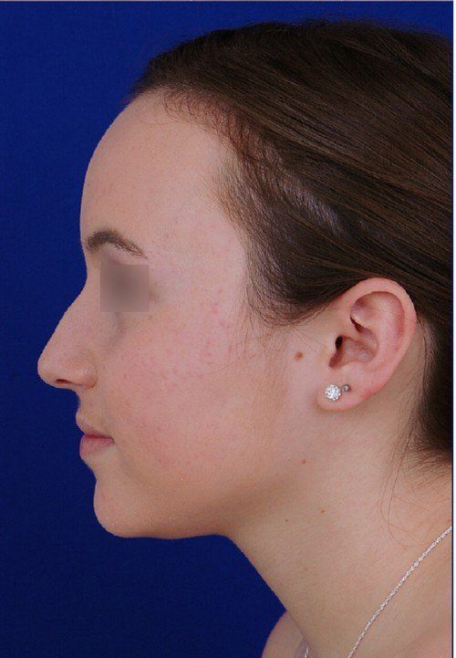 female rhinoplasty