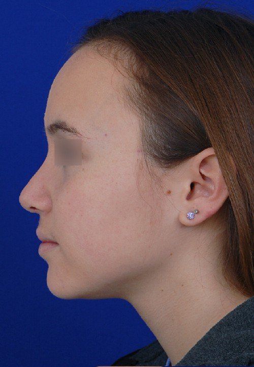 female rhinoplasty