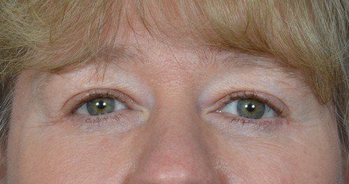 brow lift before and after