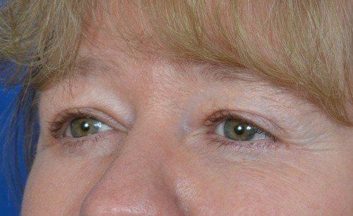 brow lift before and after