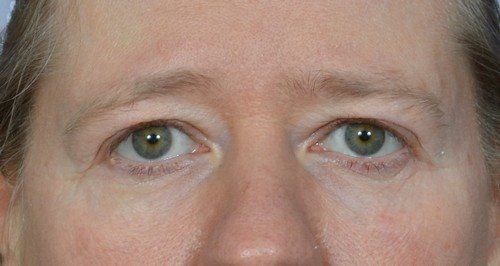brow lift before and after