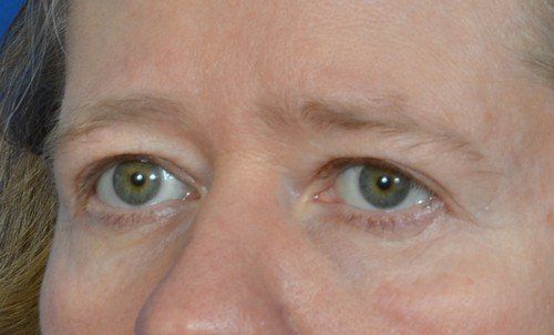brow lift before and after