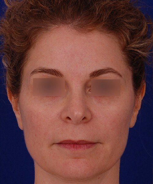 female revision rhinoplasty