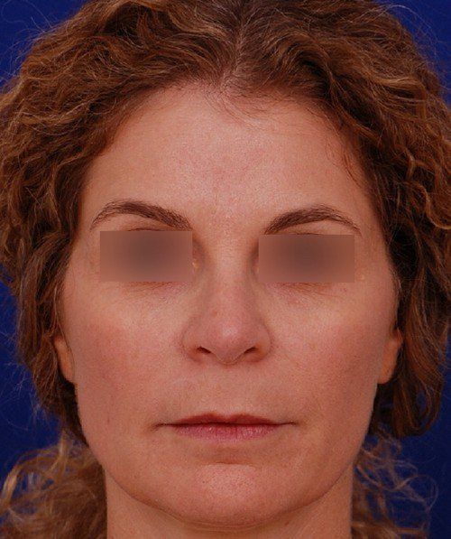 female revision rhinoplasty