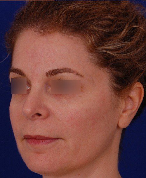 revision rhinoplasty example