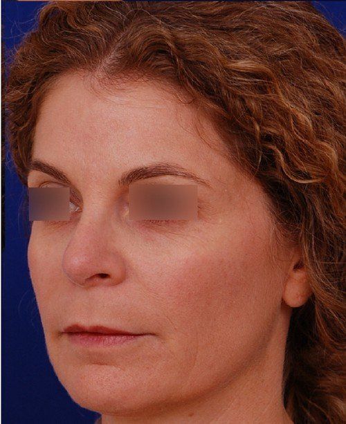 revision rhinoplasty example