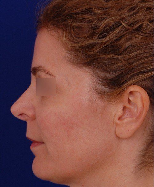 rhinoplasty side profile
