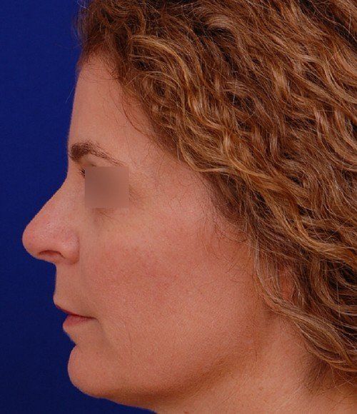 rhinoplasty side profile