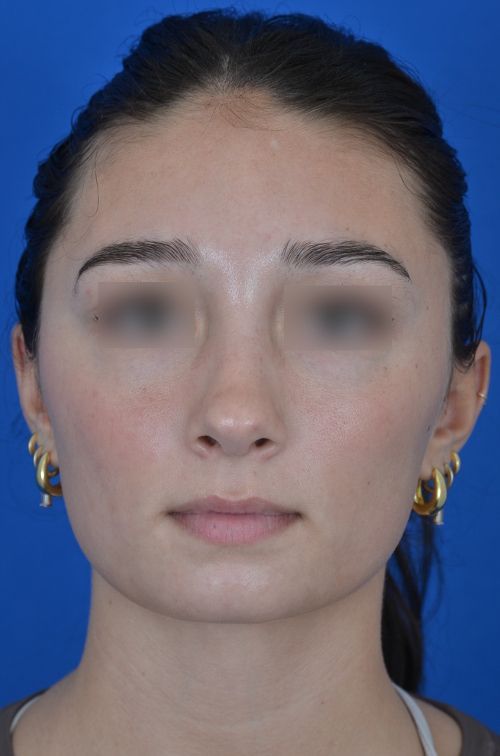 female rhinoplasty