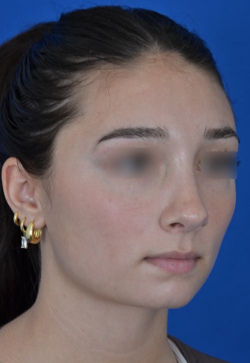 female rhinoplasty