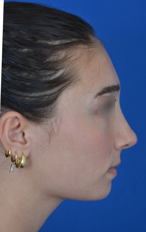female rhinoplasty