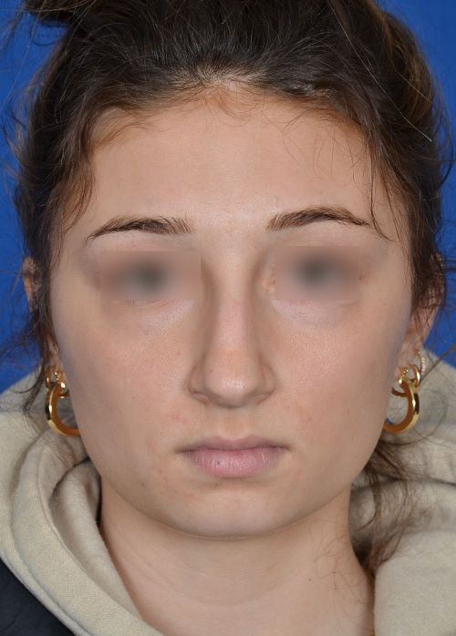 before rhinoplasty