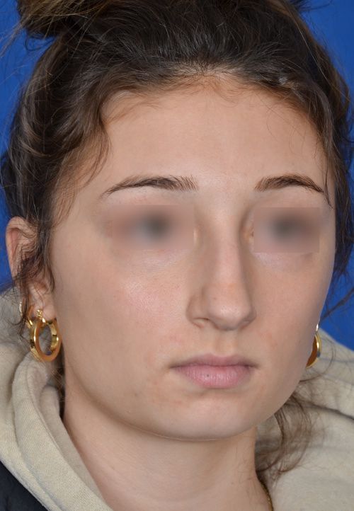 before rhinoplasty