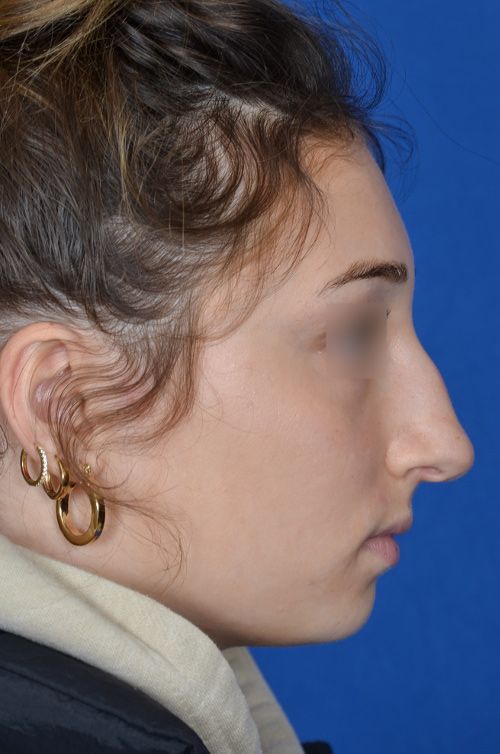 before rhinoplasty