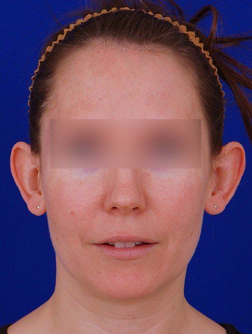 female before otoplasty