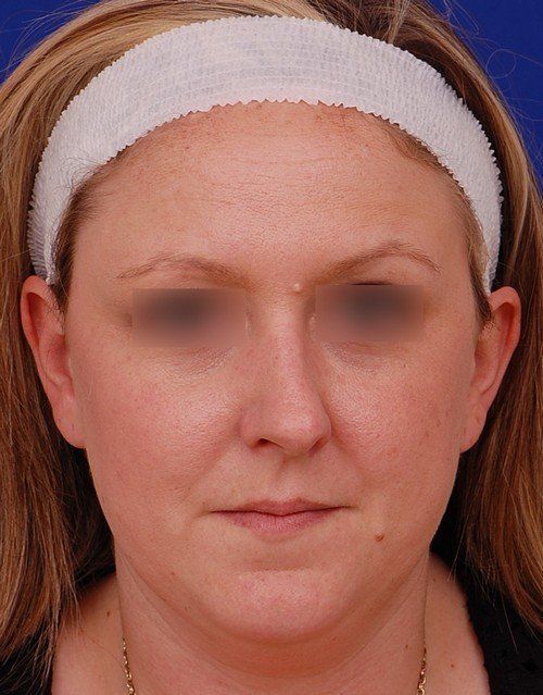 female revision rhinoplasty