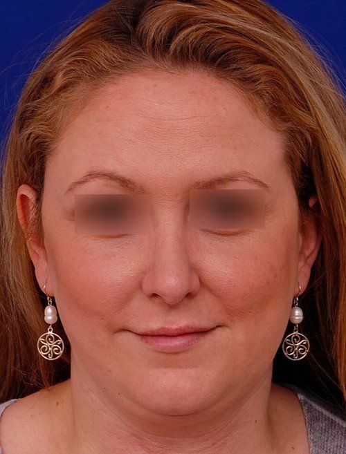 female revision rhinoplasty