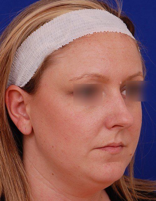 female revision rhinoplasty