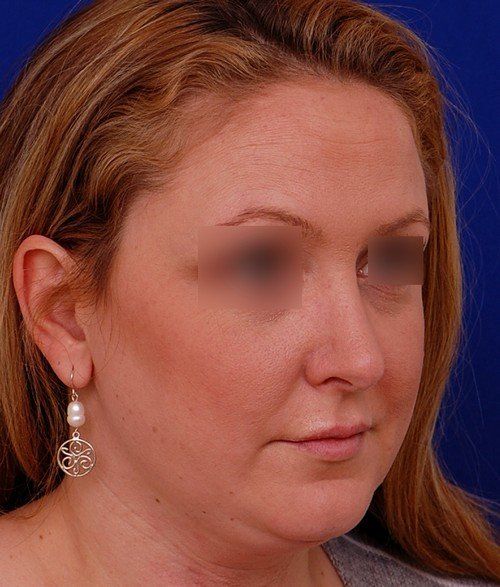 female revision rhinoplasty