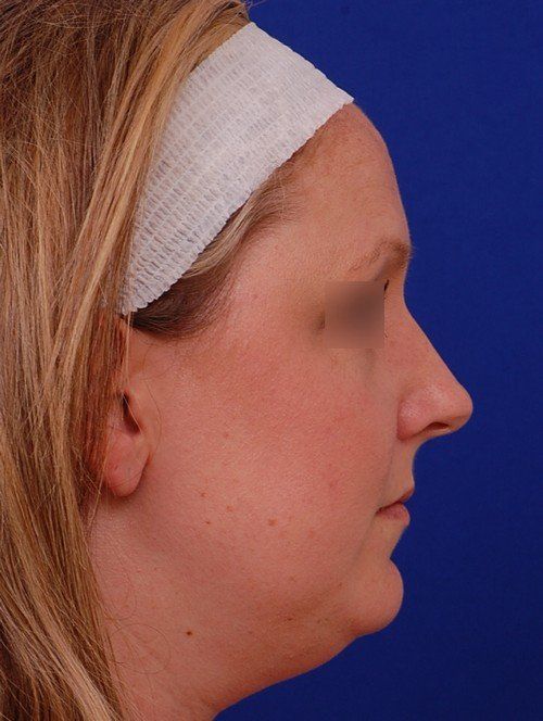 female revision rhinoplasty