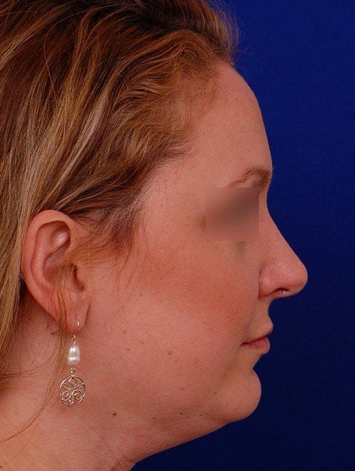 female revision rhinoplasty