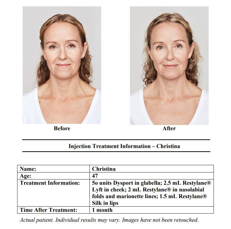 before and after restylane dysport combo