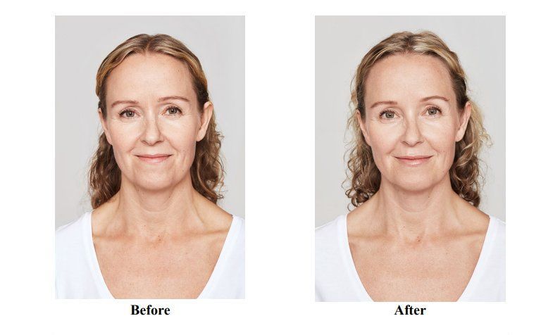 before and after restylane dysport combo trea