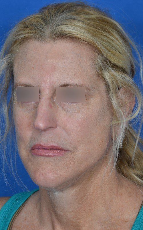 mini facelift before and after