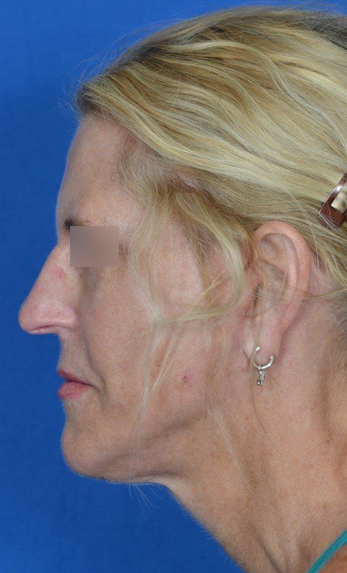 mini facelift before and after