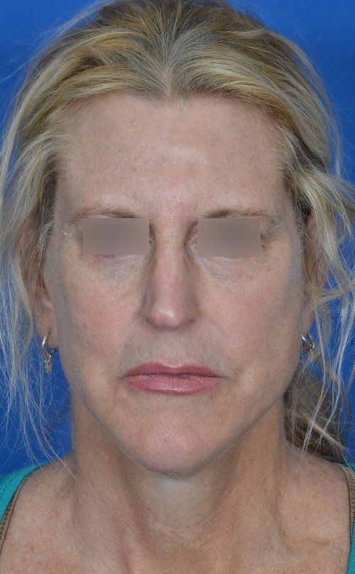 mini facelift before and after