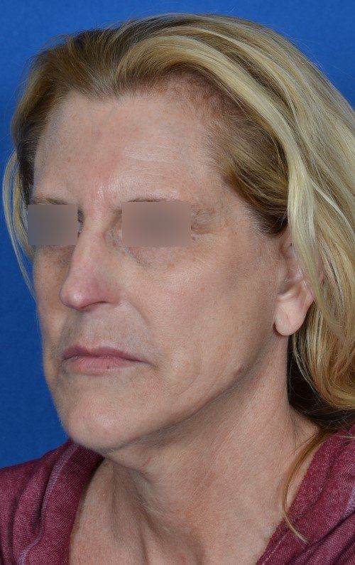 mini facelift before and after