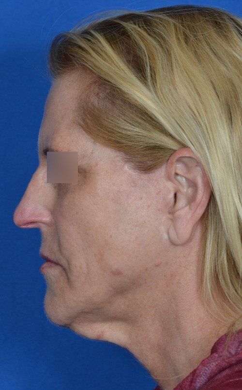 mini facelift before and after