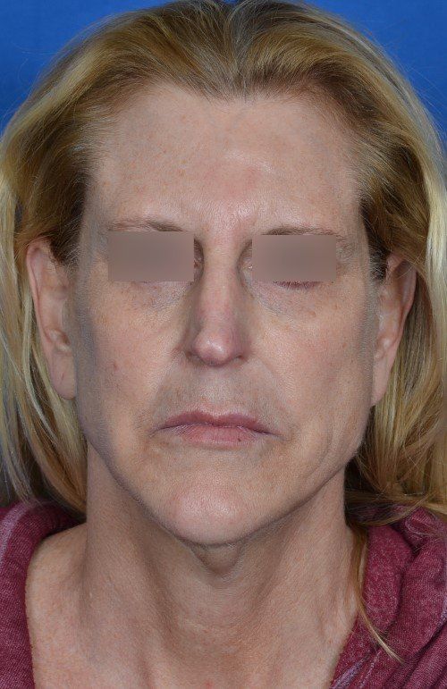 mini facelift before and after