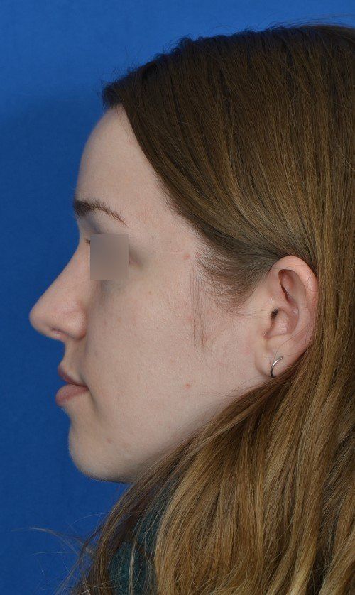 rhinoplasty side view
