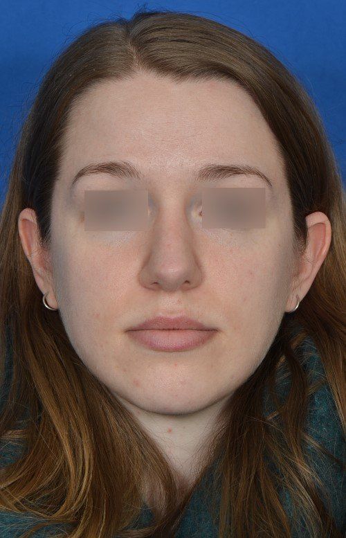 rhinoplasty