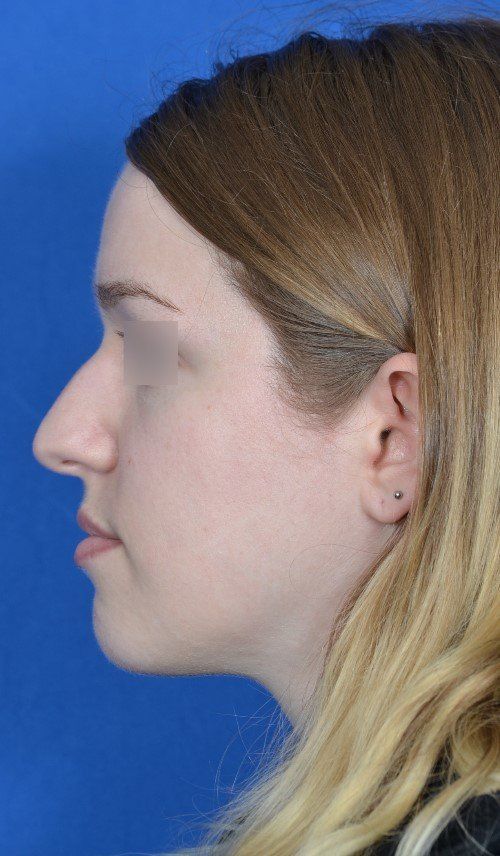 rhinoplasty side view