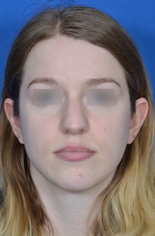 rhinoplasty