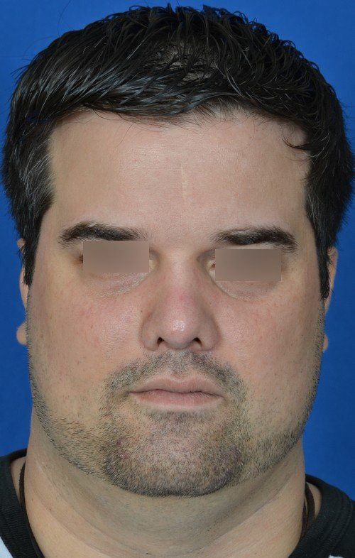 male rhinoplasty