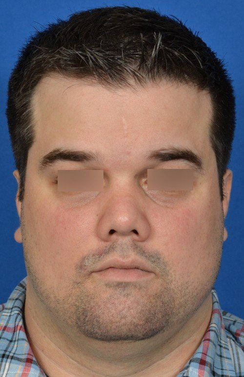 male rhinoplasty