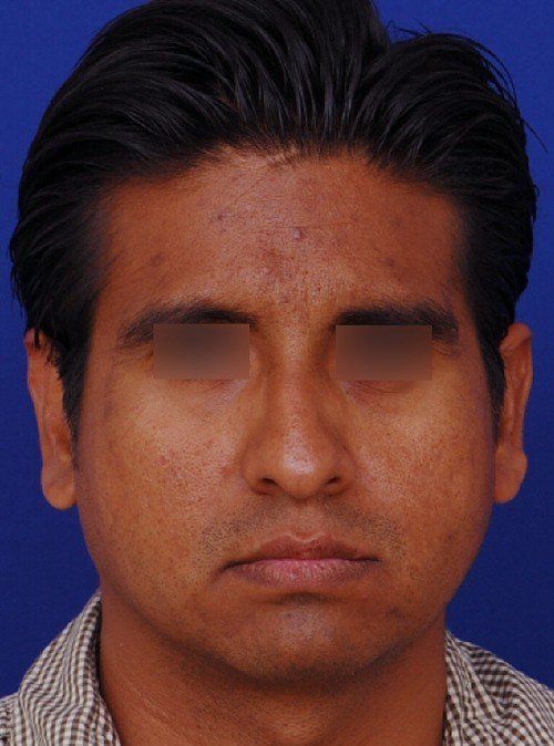 male rhinoplasty