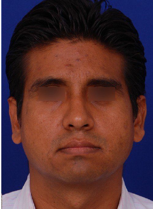 male rhinoplasty after