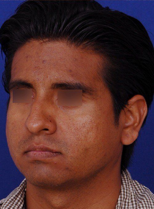 male rhinoplasty