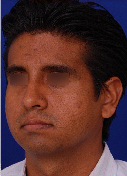 male rhinoplasty after