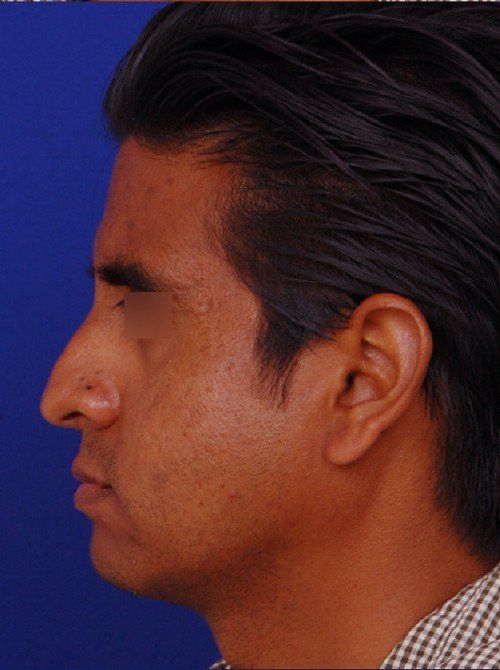 male rhinoplasty