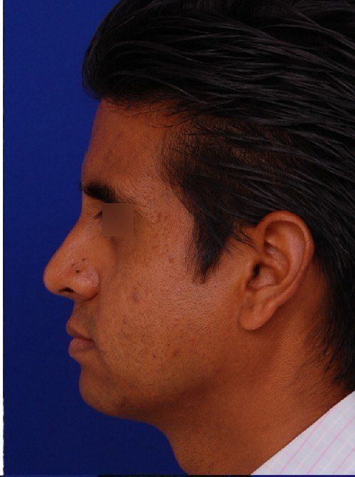 male rhinoplasty after