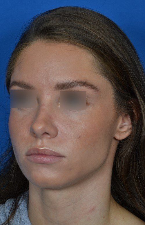 female rhinoplasty