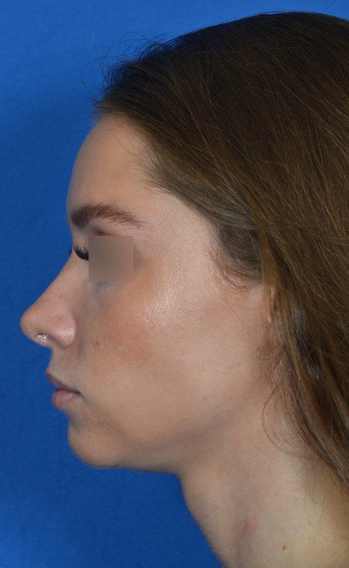 female rhinoplasty