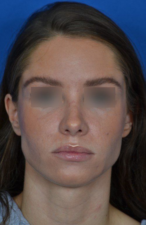 female rhinoplasty