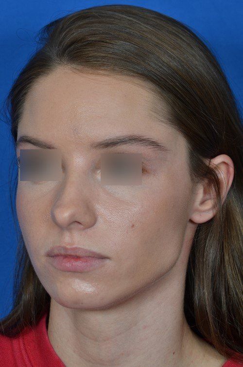 female rhinoplasty